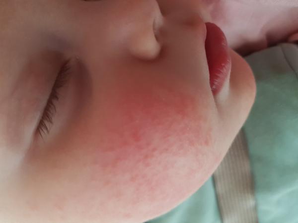 Červené teplé tvářičky s pupínky. Co by to mohlo být?