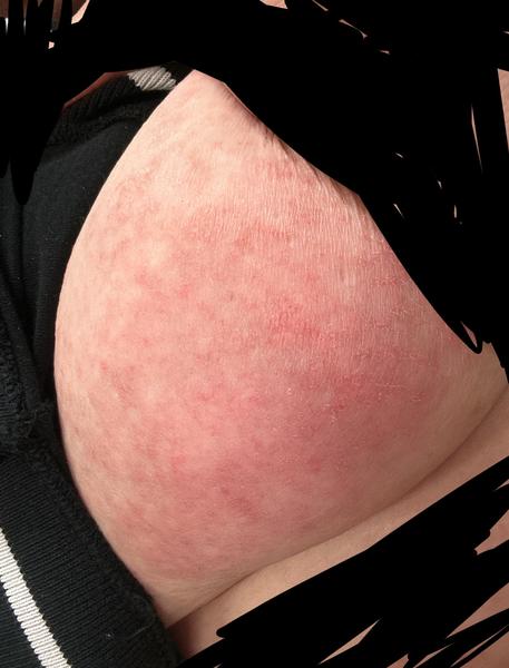 Nezabírají léčby na svědivou vyrážku. Co dělat?