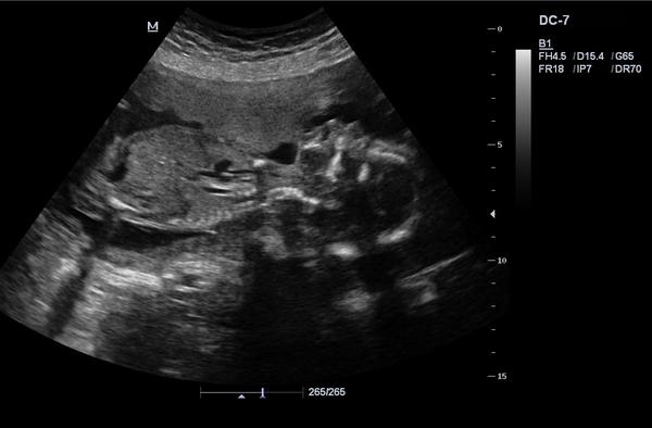 Znáte metody určování pohlaví miminka podle ultrazvuku?