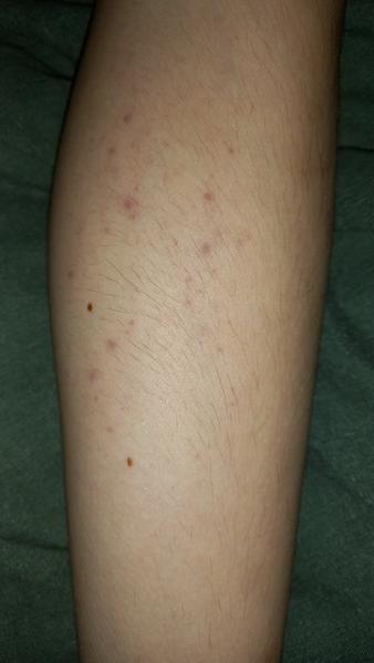 Fialové fleky u dítěte. Může jít o alergii?