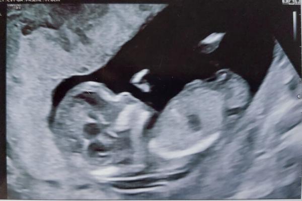 Poznáte pohlaví dítěte z ultrazvuku ve 13. týdnu?