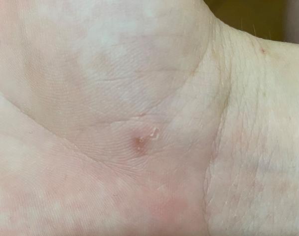 Je to ekzém nebo svrab? Rozpoznání a rady.