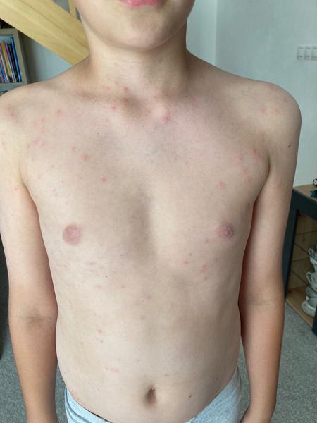 Vyrážka. Co myslíte, že by to mohlo být?