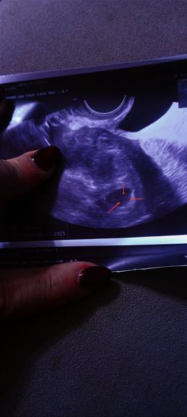 Prázdný gestační váček: Co znamená nález na ultrazvuku?