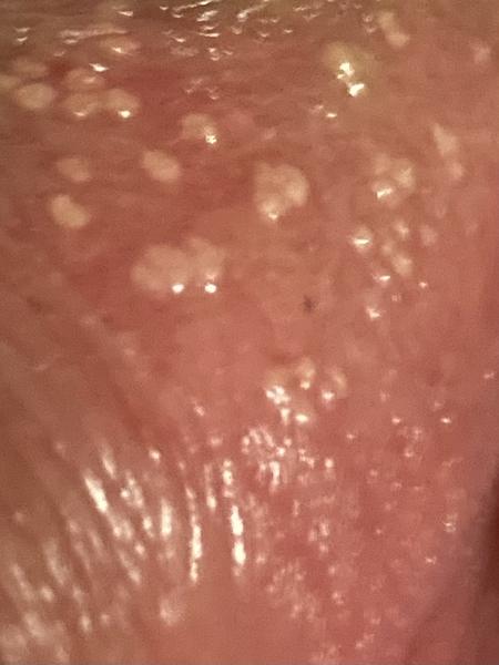 Bradavičky na genitáliích. Co by to mohlo být?