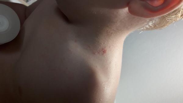 Vyrážka nebo ekzém. Poradíte, prosím, co by to mohlo být?