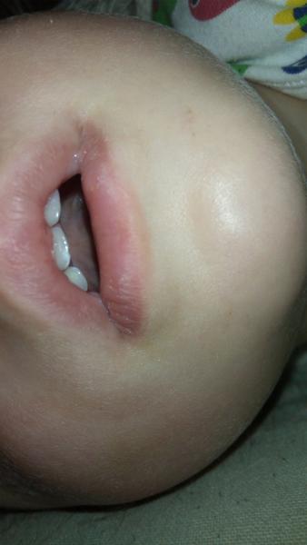 Ulomený zub 1,5letého dítětě. Řešit to se zubařem?