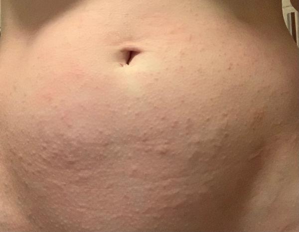 Svědivé pupínky na břiše. Jaké jsou zkušenosti?