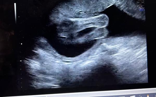 21. týden těhotenství. Jaké je, prosím, pohlaví miminka?