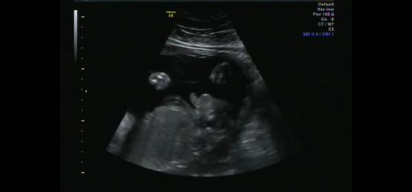 Holka nebo kluk? Matoucí výsledky ultrazvuku ve 26. týdnu