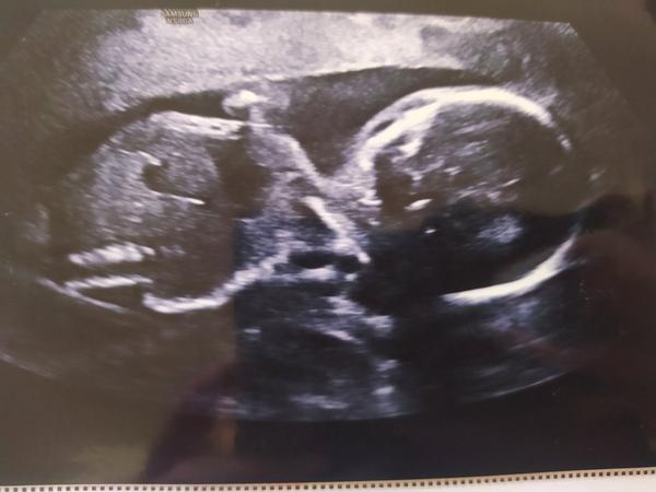 Zkušenosti s 3D a 4D ultrazvukem: Jaká je úspěšnost?