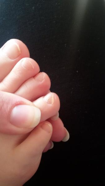 Černá čárka přes nehet na nožicce dítěte. Co to může být?