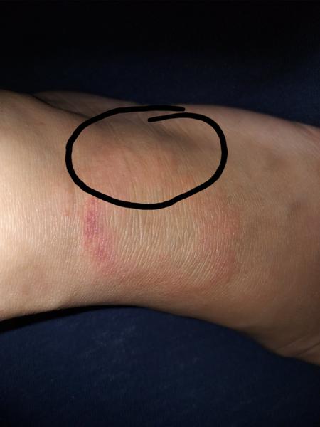 Červený flek na nártu. Borelióza, mykóza nebo něco jiného?