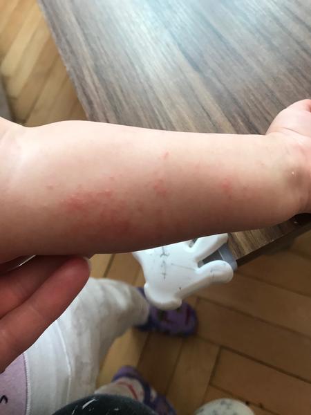 Vyrážka nebo ekzém. Co by to mohlo být? Volat naší dr.?