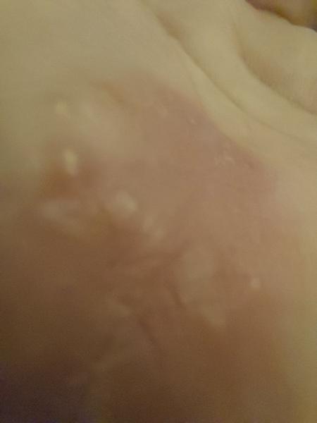 Je normální mít puchýřky s hnisem měsíc po operaci?