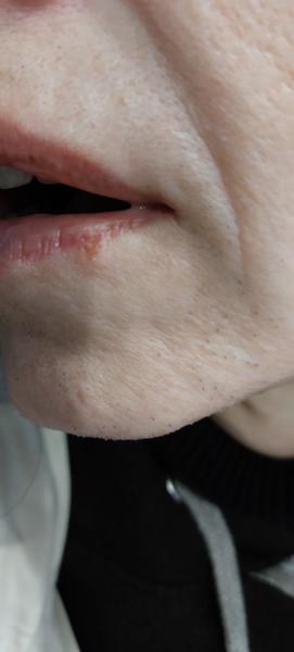 Je opar po týdnu mazání Herpesinem zhojený?