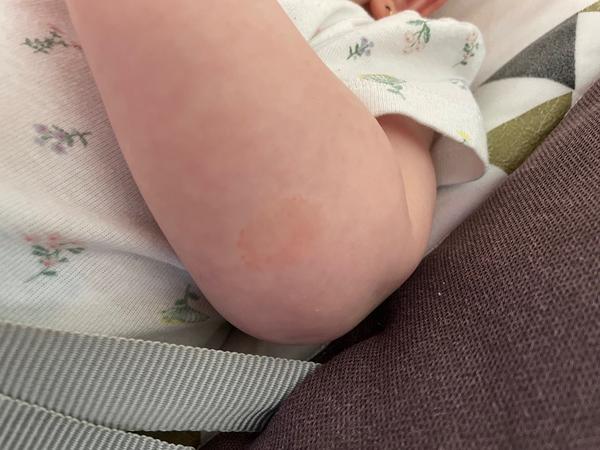 Co způsobuje fleky na kůži u kojenců?