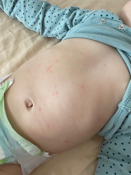 Vyrážka. Co myslíte?