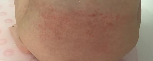 Vyrážka na zádech. Co by mohlo pomoci a čím mazat?