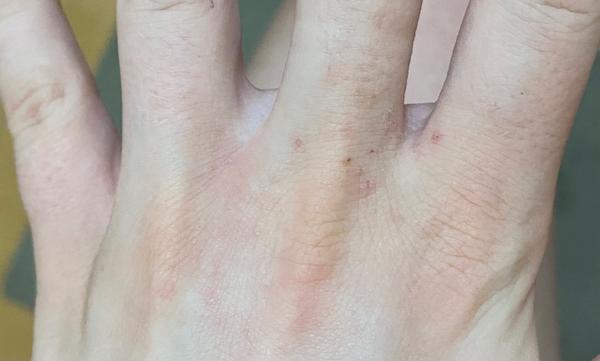 Je to ekzém nebo svrab? Rozpoznání a rady.