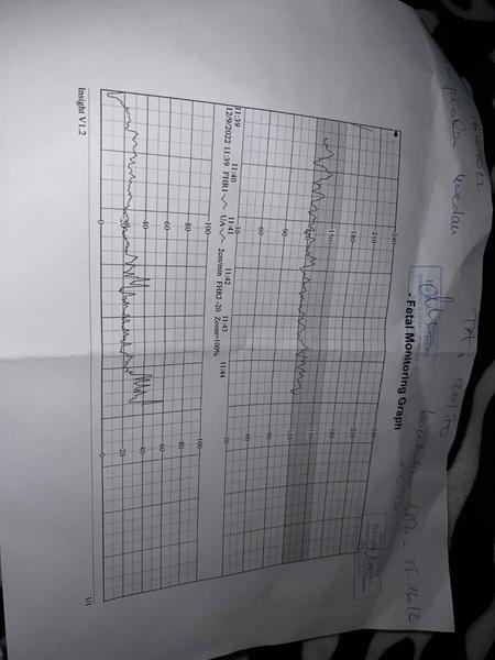 Blíží se porod při těchto hodnotách CTG?