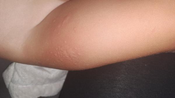 Je to kopřivka nebo něco jiného?