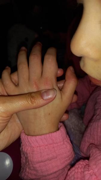 Alergie na Erythromycin u dcery? Zkušenosti a radu prosím!