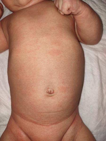 Může mít moje dvouměsíční dítě atopický ekzém?