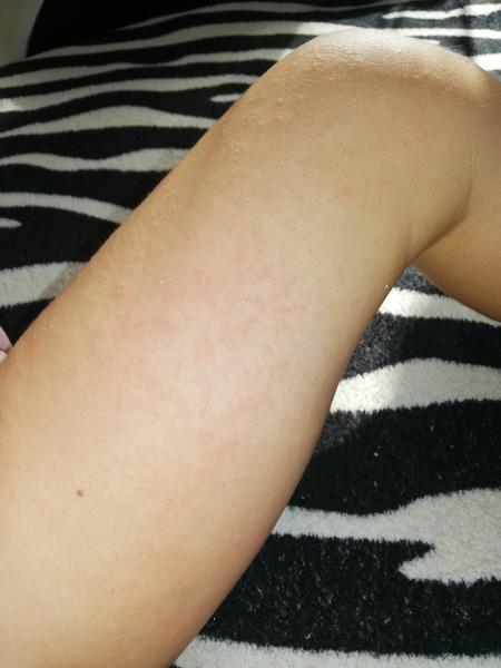 Vyrážka u dítěte. Mohla by pomoci mast Fenistil?