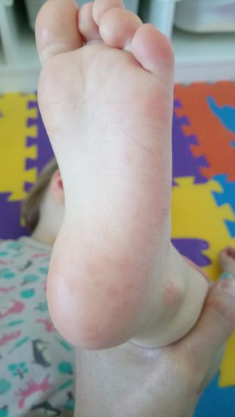 Vyrážka - trvá už skoro měsíc. Je to nakažlivé?