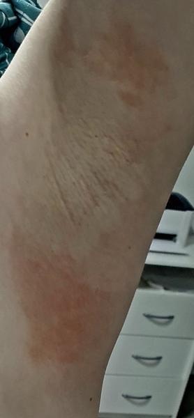 Vyrážka v podpaží po holení: Jak ji léčit?