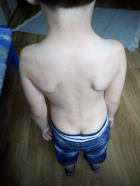 Mohou to být pupínky ze slunce?