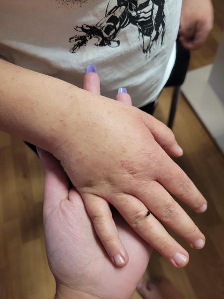 Svědivé pupínky. Co by to mohlo být?