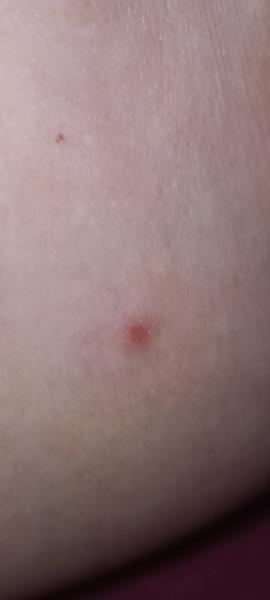 Pupínek nad prsním dvorcem. Může souviset s plaváním na krytém bazénu?