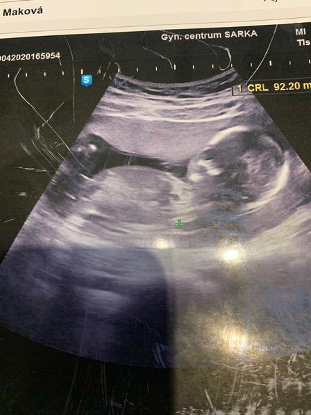 Poznáte pohlaví dítěte v 17+0?