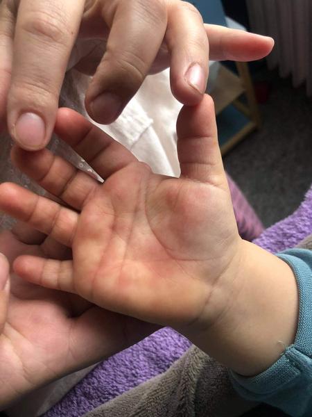 Červené fleky na dlani. Co by to mohlo být?