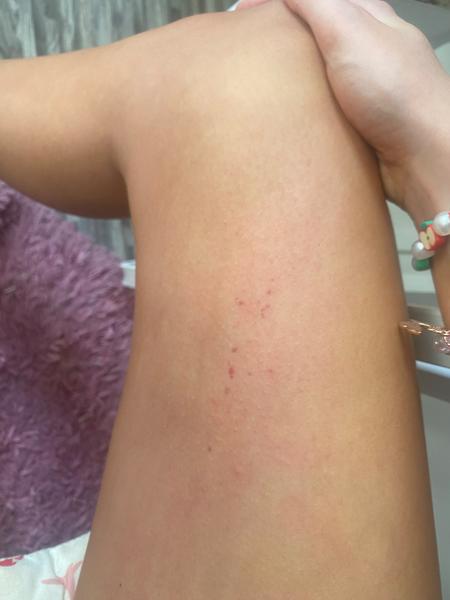 Štípnutí od roztoče nebo jiného parazita během spánku?