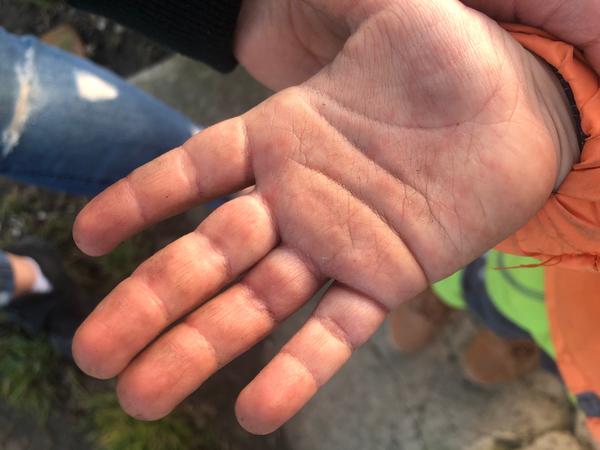 Vyrážka. Co by to mohlo být?