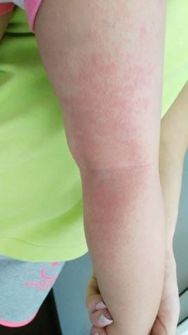 Vyrážka na nožičce