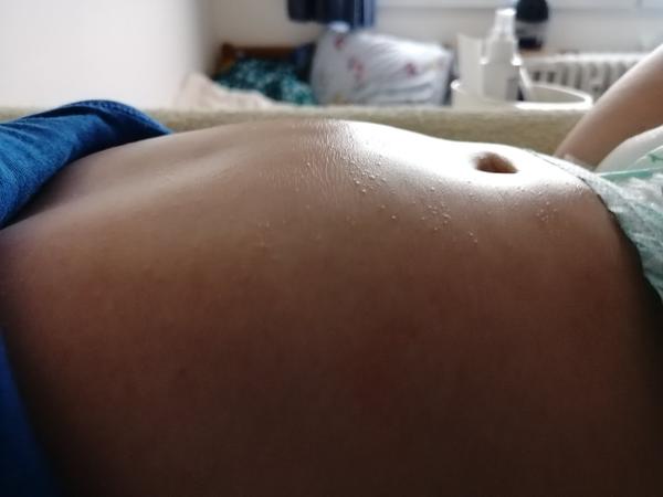 Je vyrážka na bříšku dítěte alergie nebo ekzém?