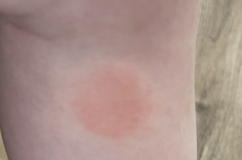 Jak poznat boreliózu u dítěte po klíštěti?