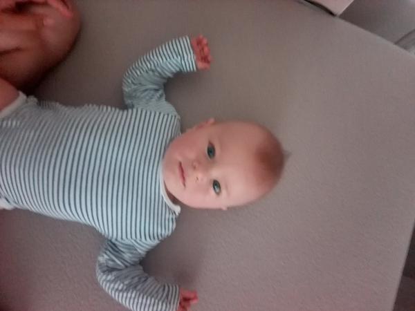 Downův syndrom - příznaky