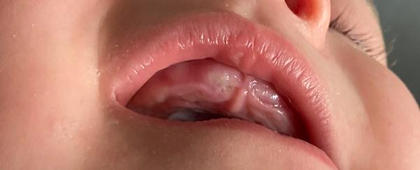 Normální bílý flek při prořezávání zoubků?