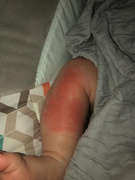 Červéné fleky na nožičkách