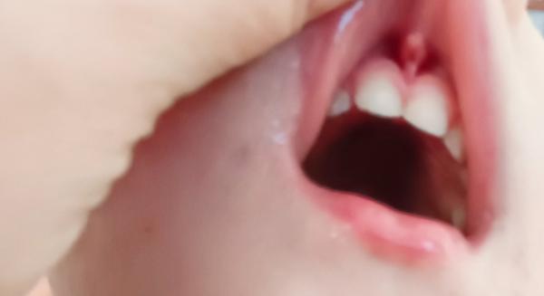 Mám jet s utrženou uzdičkou u dítěte na šití?