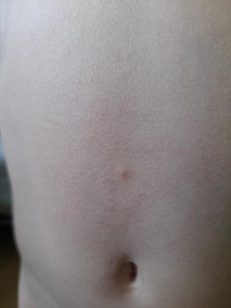 Jsou to opravdu neštovice? Zjistěte, jak je poznat!