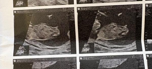 Screening ve 12. týdnu. Lze odhadnout pohlaví?