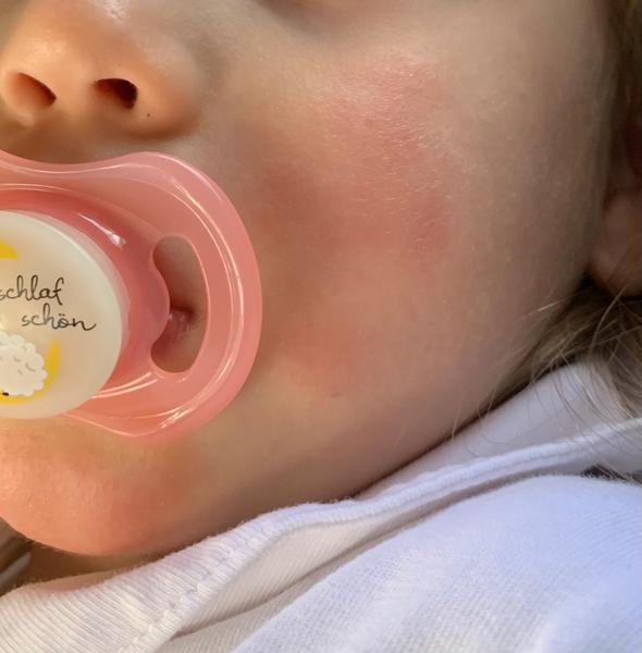 Ekzém na tvářích. Co může být příčinou? Čím mazat a umývat?