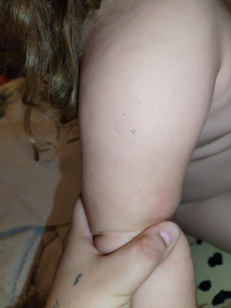 Kožní alergie nebo štípance? Zkušenosti s neobvyklými projevy na kůži.