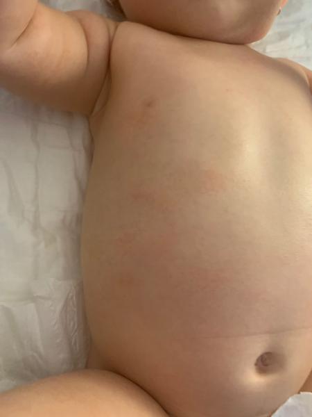 Vyrážka. Je lepší navštívit lékaře?